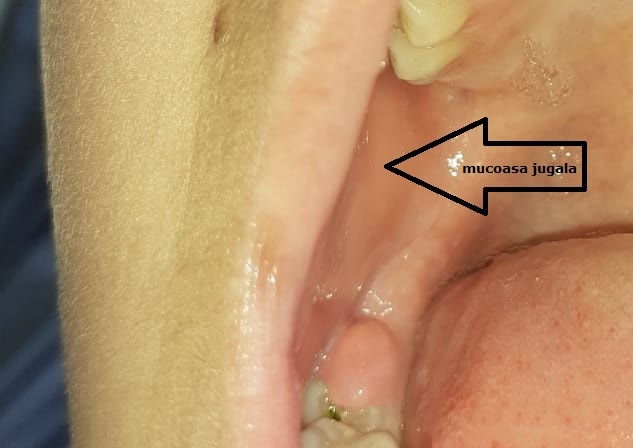 Imagine detaliată a mucoasei jugale, evidențiind structura și aspectul acesteia.
