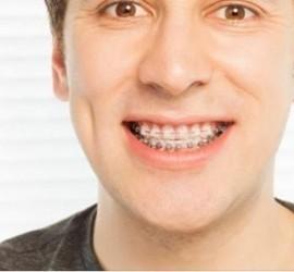 Bărbat zâmbind cu aparat dentar metalic pe dinți, având un fundal luminos.