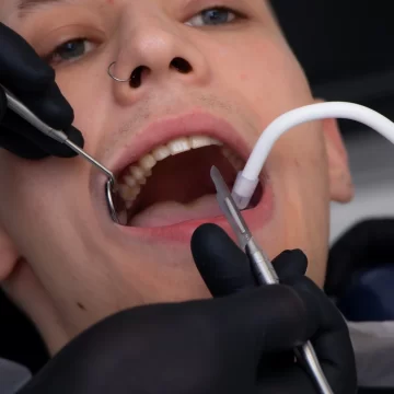 halitoza - mirosul urat al gurii