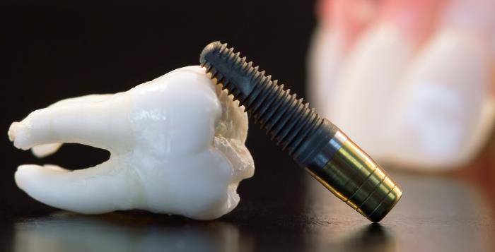implant dentar riscuri
