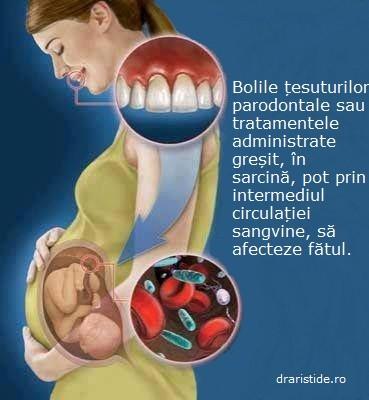 Tratamentul stomatologic in sarcina