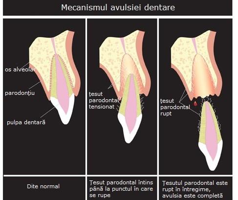 Avulsia dentară, o urgență stomatologică. - IVORY Dentfix