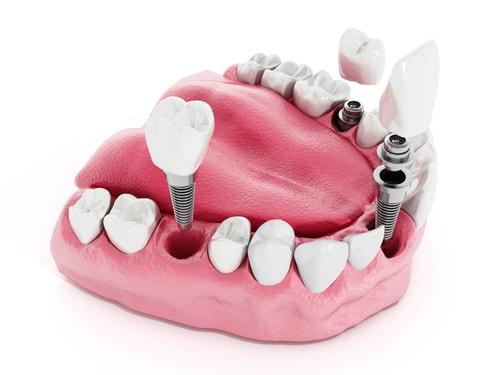 Implant dentar preturi