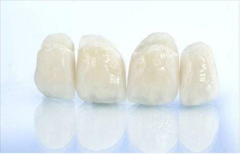Descementarea coroanelor ceramice de pe dinții anteriori