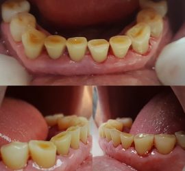 Imagini ale unei danturi umane cu semne de abraziune dentară pe dinți.