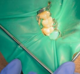Instrumente dentare utilizate pentru testarea sensibilității dentare pe un pacient.