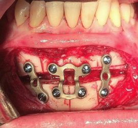 Imagine a unei intervenții chirurgicale dentare cu plăci metalice și șuruburi vizibile în cavitatea bucală.