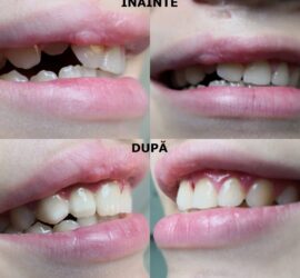 Imagine comparativa a dintilor inainte si dupa tratament dentar, aratand diferentele vizibile.