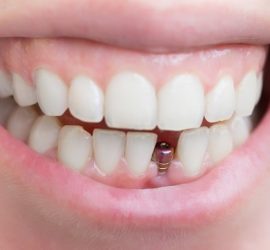 Zâmbet cu dinți albi și un implant dentar vizibil între incisivii centrali.