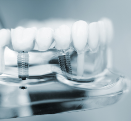Model de maxilar transparent cu două implanturi dentare vizibile în zona molarilor.