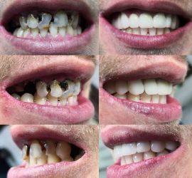 Poze dinti zirconiu, coroane dentare zirconiu