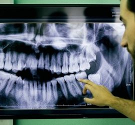 Radiografie dentară care arată dinții și măselele unui pacient, cu un medic care indică o zonă specifică.