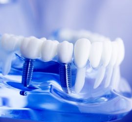 Model de maxilar cu dinți artificiali și implanturi dentare vizibile.