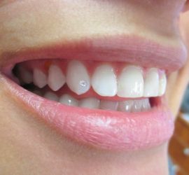 Un zâmbet cu bijuterii dentare aplicate pe dinți, evidențiind strălucirea acestora.