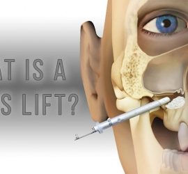 Ilustrație care arată un model al feței umane cu un dispozitiv pentru sinus lift.