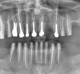 Radiografie panoramică a dinților, arătând structura dentară și implanturile.