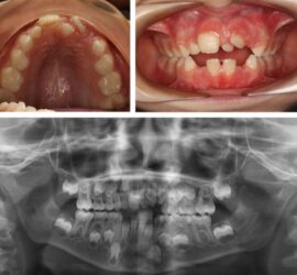 Imagini dentare care includ o radiografie și observații ale cavității bucale.