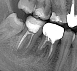 Radiografie dentară care arată dinții și rădăcinile acestora, evidențiind structura dentară.