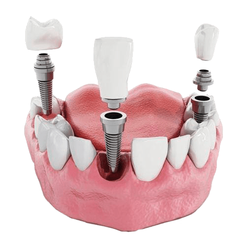 Implant dentar pret, descriere, etape.