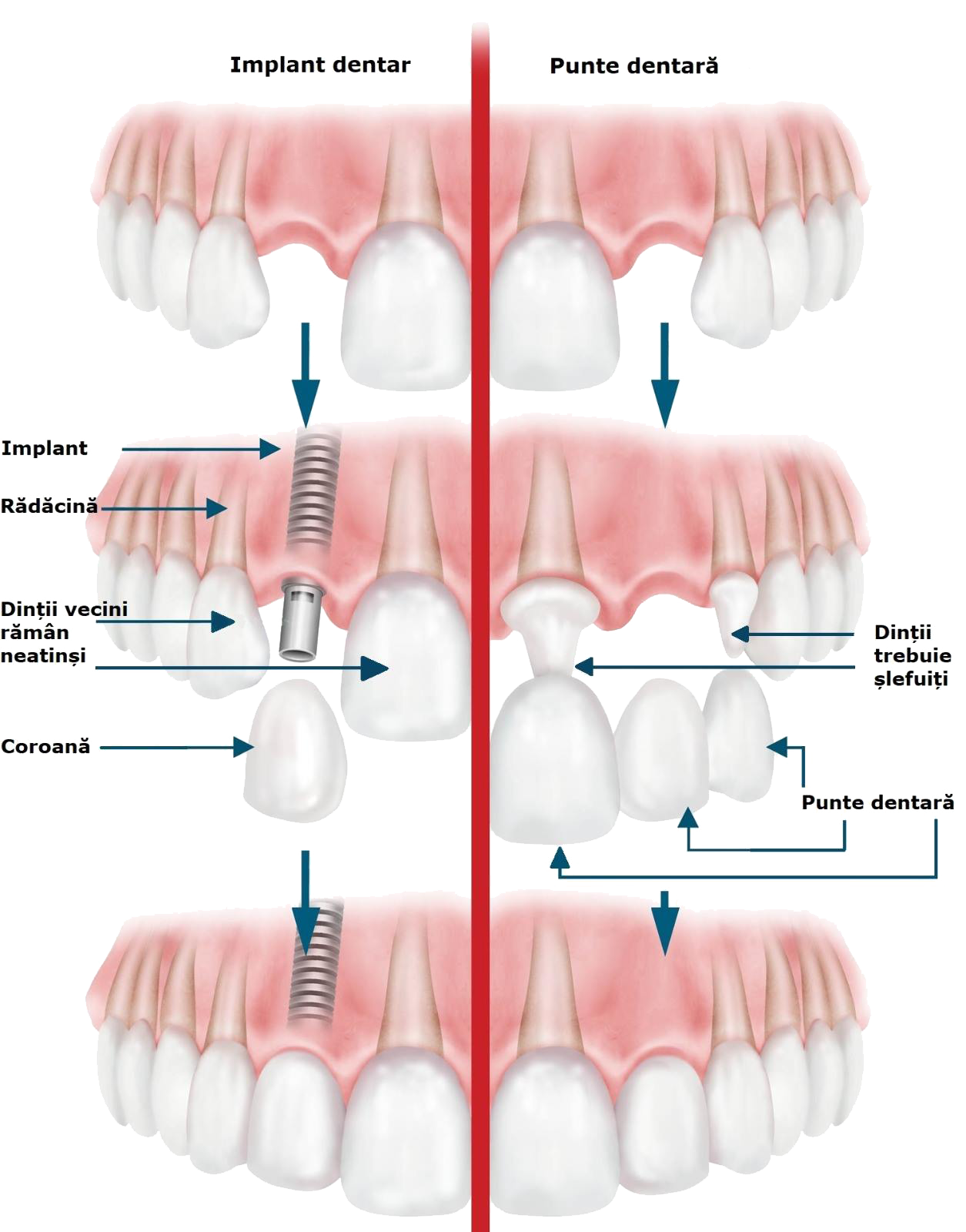 implant dentar sau punte dentara