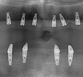 Radiografie dentară care arată mai multe implanturi dentare în maxilarul inferior.