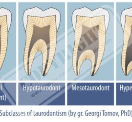 Ilustrație a subclaselor taurodontismului: normal, hipotaurodont, mezotaurodont și hipertaurodont.