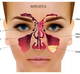 Ilustrație a sinuzitei, arătând structurile sinusurilor și inflamația asociată.