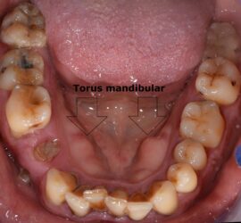 Imagine a torus mandibular vizibil în cavitatea bucală, cu dinți și gingii vizibile.