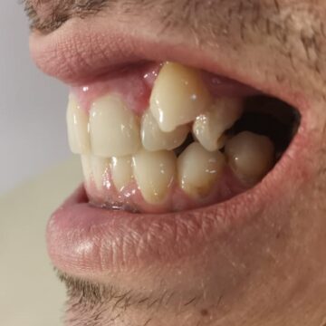 anchiloza dento alveolara