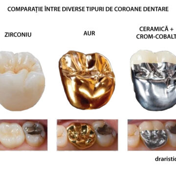 Comparatie. Coroana de zirconiu versus alte coroane