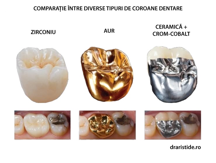 Coroana dentara comparatie - versus tipuri de materiale.
