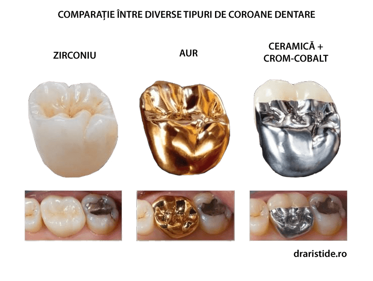 Nominal Bend feasible Coroana dentara comparatie - Zirconiu versus alte tipuri de materiale.