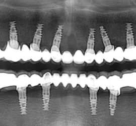 Radiografie dentară care arată implanturi dentare în maxilarul superior și inferior.