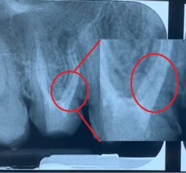 Radiografie dentară care arată o fractură radiculară evidențiată prin cercuri roșii.