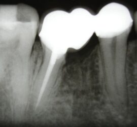 Radiografie dentară care arată dinți și rădăcinile acestora în detaliu.