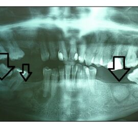 Radiografie dentară care arată un cementoblastom în maxilarul inferior.