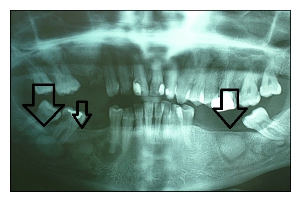 Radiografie dentară care arată un cementoblastom în maxilarul inferior.