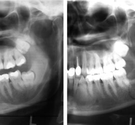 Radiografie dentară care arată structura mandibulei și dinții inferiori.
