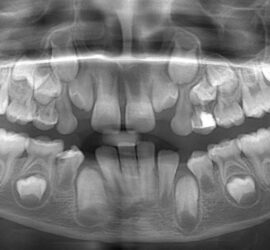 Radiografie dentară care arată dinții unui copil, inclusiv molarii și incisivii.