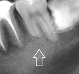 Radiografie dentară care arată rădăcinile dinților și structura osului maxilar.