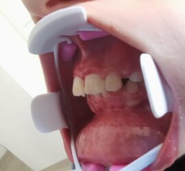 Imagine a cavității orale cu dinți vizibili și un dispozitiv de expunere dentară.