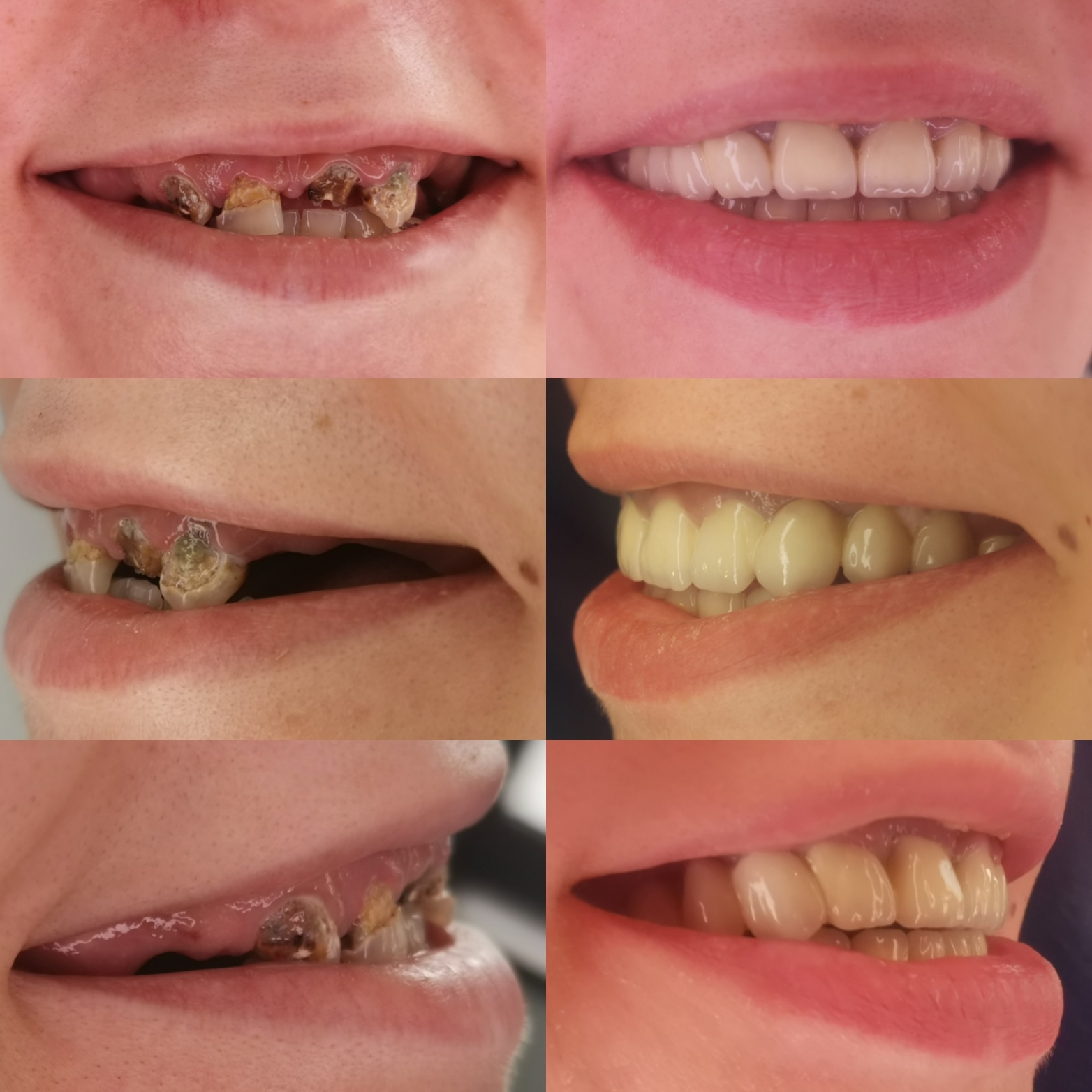 Dental crowns in Bucharest