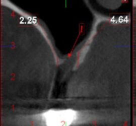 Radiografie care ilustrează perforarea membranei sinusale cu măsurători indicate.