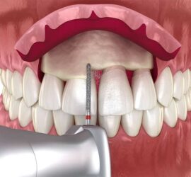 Ilustrație 3D a unui tratament dentar pentru alungirea coroanei, arătând un instrument dentar în apropierea dinților.