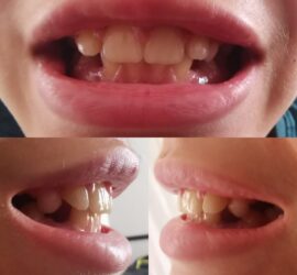 Imagine cu dinți de adolescent, arătând o dentiție mixtă cu dinți de lapte și dinți permanenți.