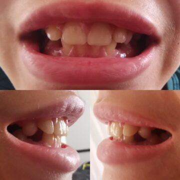 Decolorarea dinților temporari