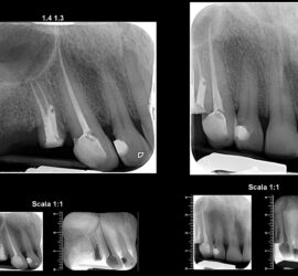 Radiografii dentare care arată dinți devitalizați, cu detalii despre rădăcini și canalul radicular.