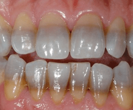 Dinti cu pete de tetraciclină, evidențiind decolorarea și variațiile de nuanță ale smalțului dentar.