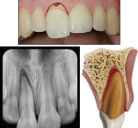Imagine care ilustrează un dinte extras, radiografie dentară și diagramă a structurii dentare.