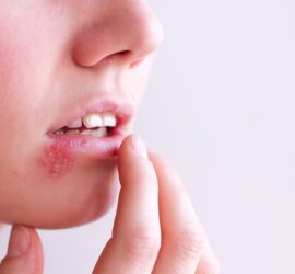 Persoană cu leziune pe buze, cauzată de herpes, atingându-și buzele cu degetul.